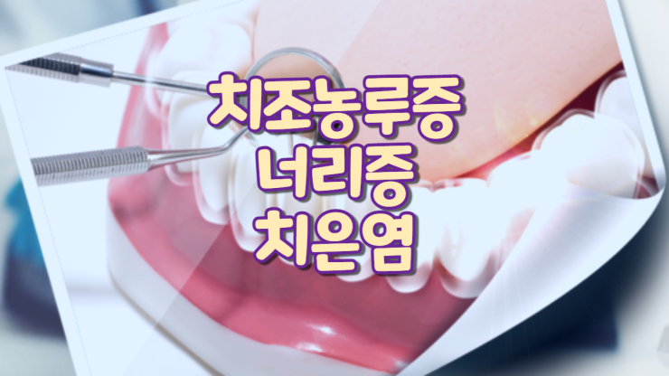  치조농루증(너리증, 치은염)