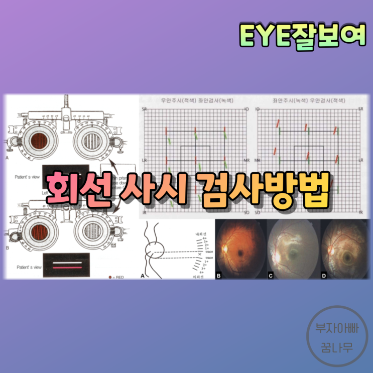 [EYE잘보여] '회선사시(Cyclotorsion), 회전사시'는 어떻게 검사할까?