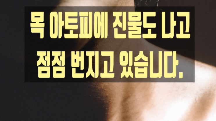  목 아토피에 진물도 나고 점점 번지고 있습니다