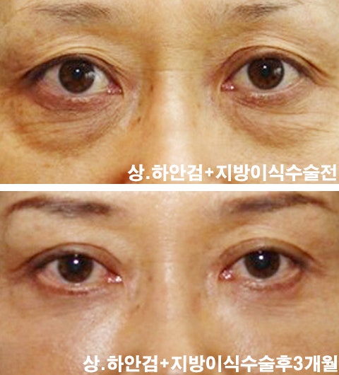 When will the scar from the lower eyelid surgery disappear and how should it be managed?