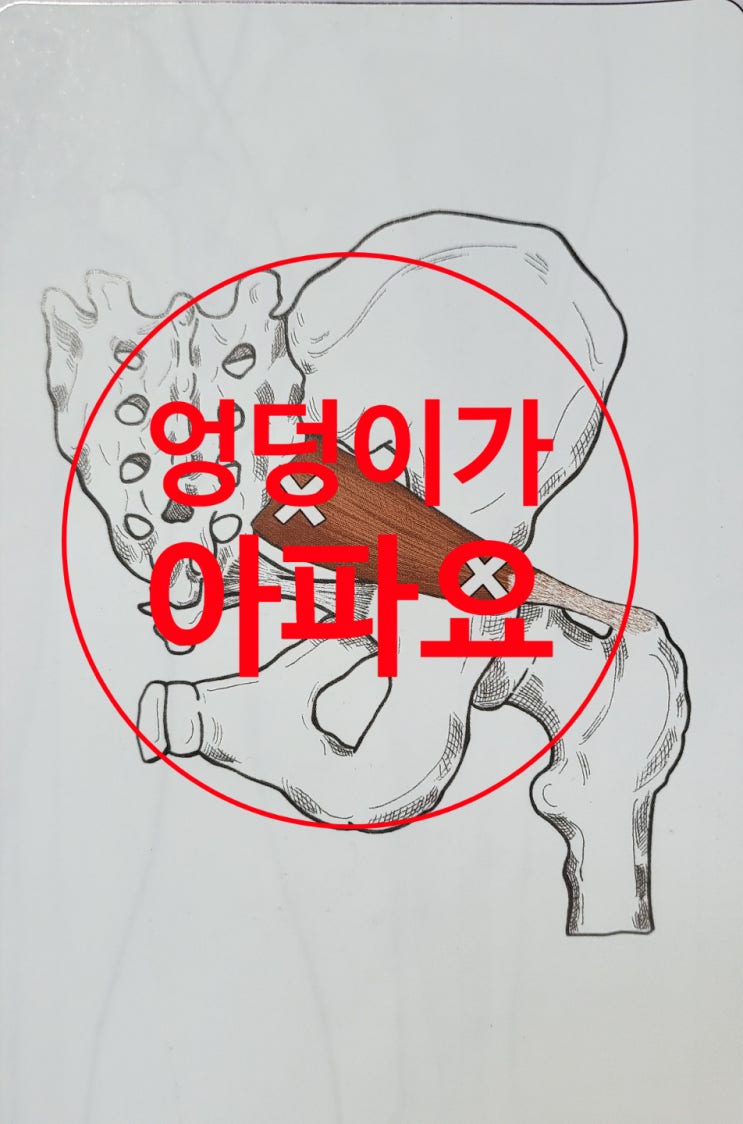  엉덩이가 아파요