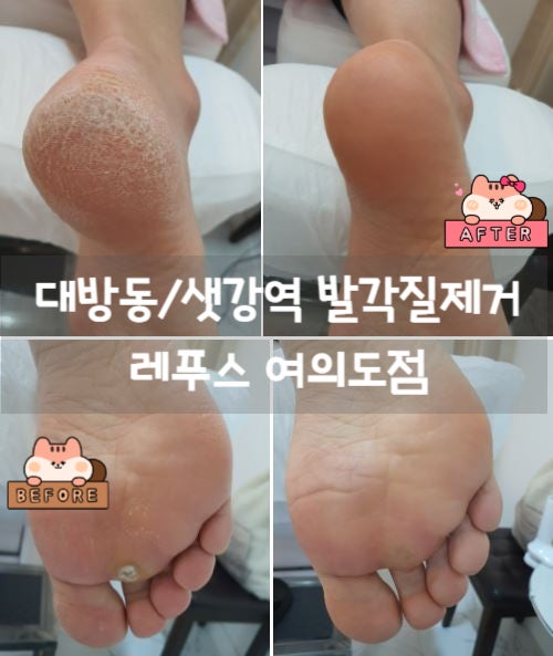  대방동/샛강역 발각질관리 레푸스 여의도점에서 각질제거와 티눈제거 솔직후기