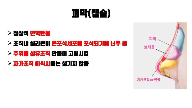  복코 교정하려고 코수술 받았는데 코끝이 더 커졌다면?