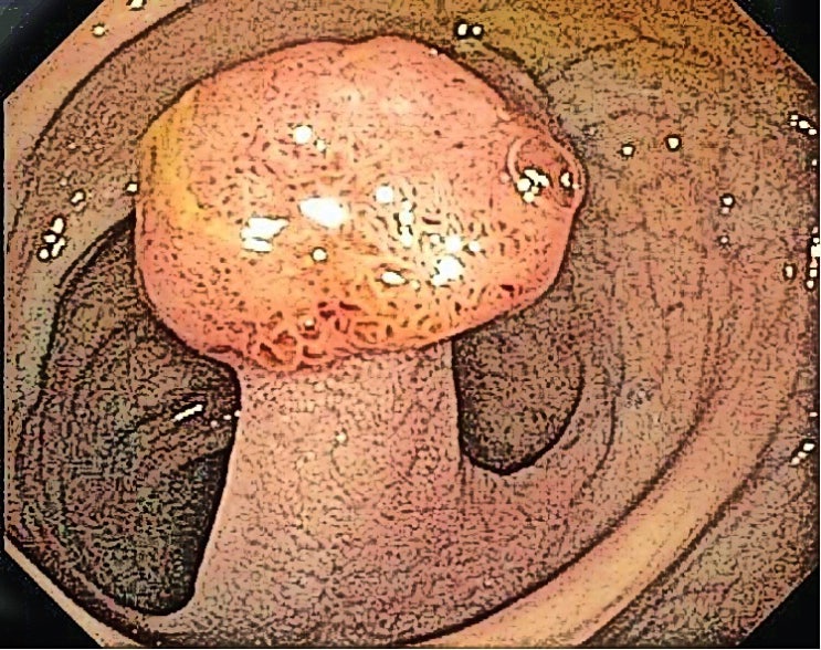  노원구 대장내시경을 해도 대장암을 발견하지 못하는 이유? 중간암, 톱니형 선종