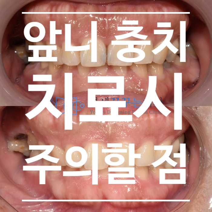 앞니 충치 레진 치료, 심미적인 고려 사항