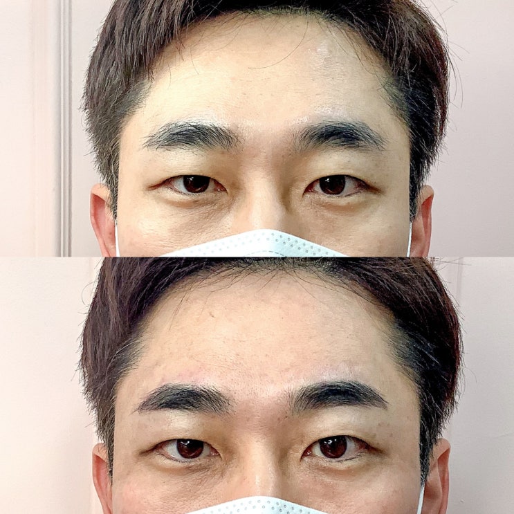  삼성역남자눈썹, 패더링기법으로 아프지도 않고 너무 존잘이 되었다.