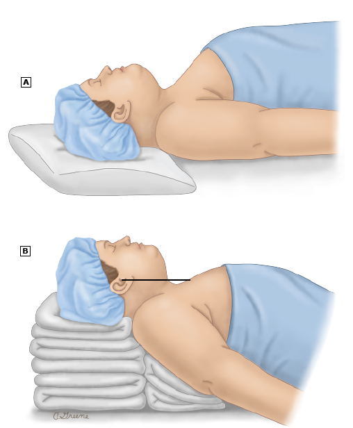  Rapid sequence induction and intubation(RSII) 신속 기관내삽관이 뭔가요?