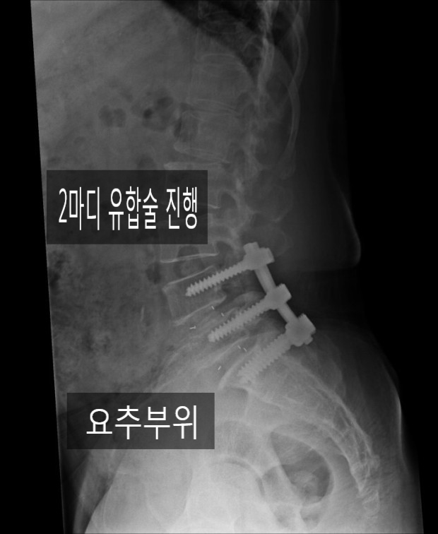 척추의 방출성골절 사례