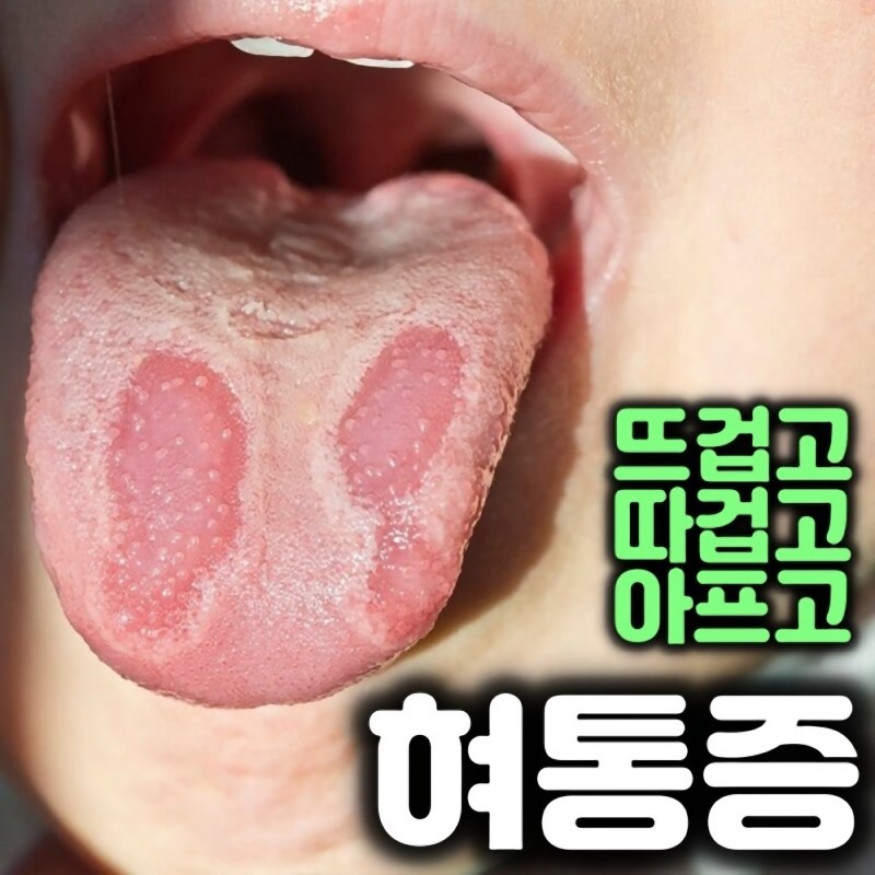 혀통증, 구강작열감 증후군 치료 : 혀돌기 혀화끈거림 따갑고 뜨거워! 입에서쓴맛, 미각 잃는 이 병?