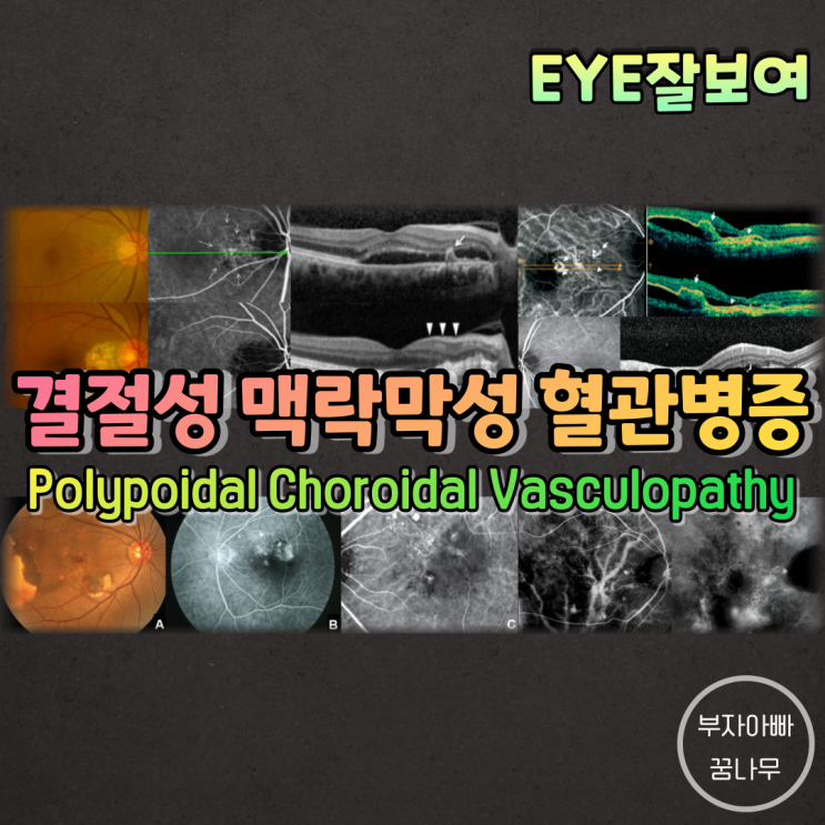 [EYE잘보여] 결절성 맥락막 혈관병증(Polypoidal Choroidal Vasculopathy; PCV)
