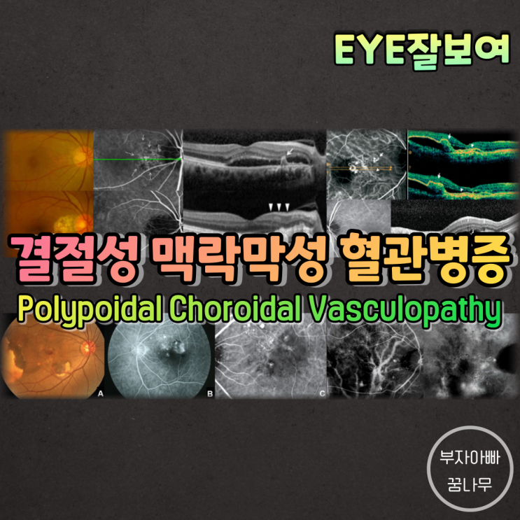  [EYE잘보여] 결절성 맥락막 혈관병증(Polypoidal Choroidal Vasculopathy; PCV)