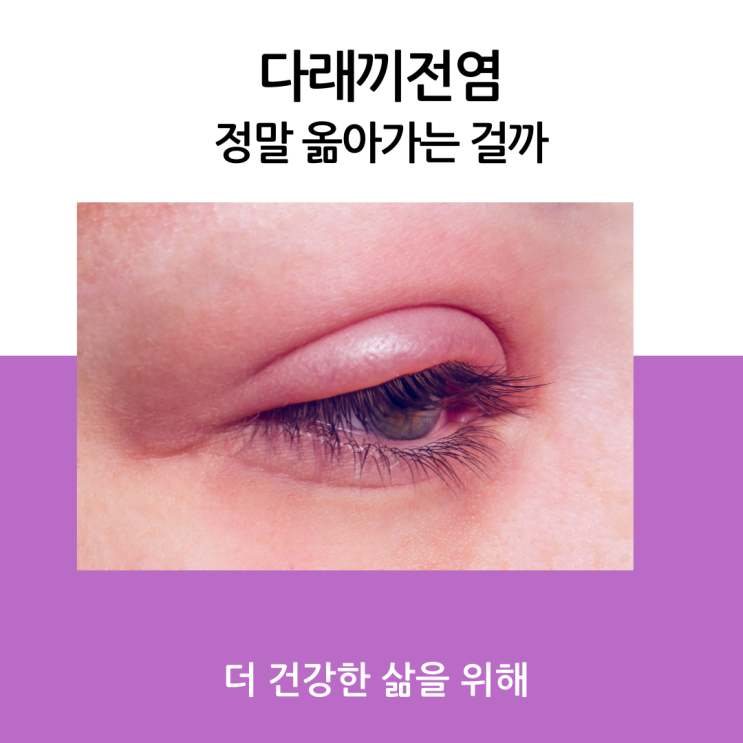 다래끼 전염 정말 옮아가는 걸까?
