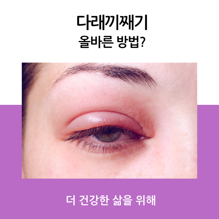  다래끼째기 제거에 올바른 방법은 어떤게 있을까요?