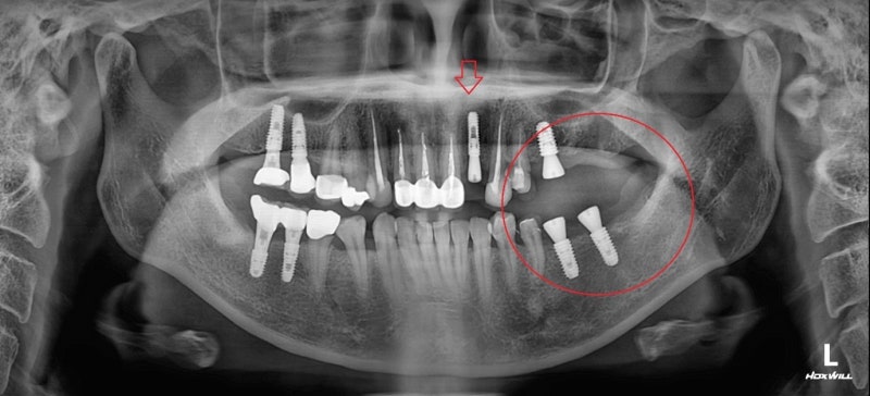 신길동 임플란트 염증 무시하면 어떻게 될까 9