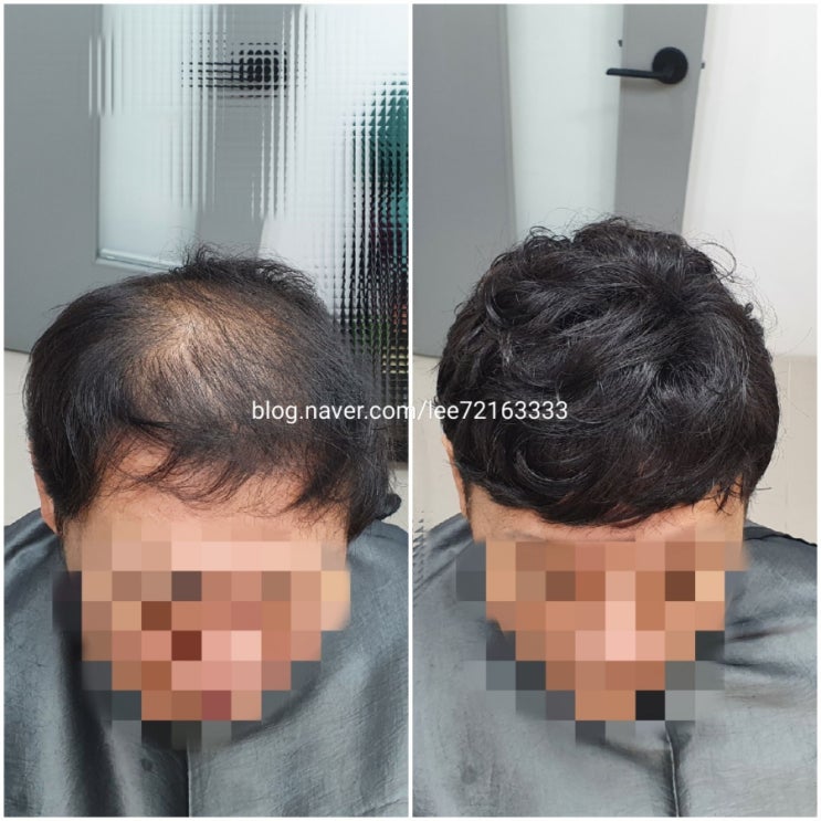  보톡스증모술 왜 약산성 팩ㆍ린스를 써야하는 이유![춘천가발전문점/가발덕후은주누나]