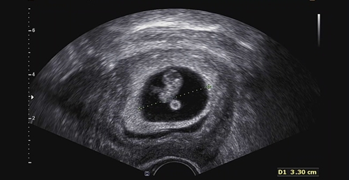 임테기 확인 후 산부인과 첫 방문 (임신확인서 발급)