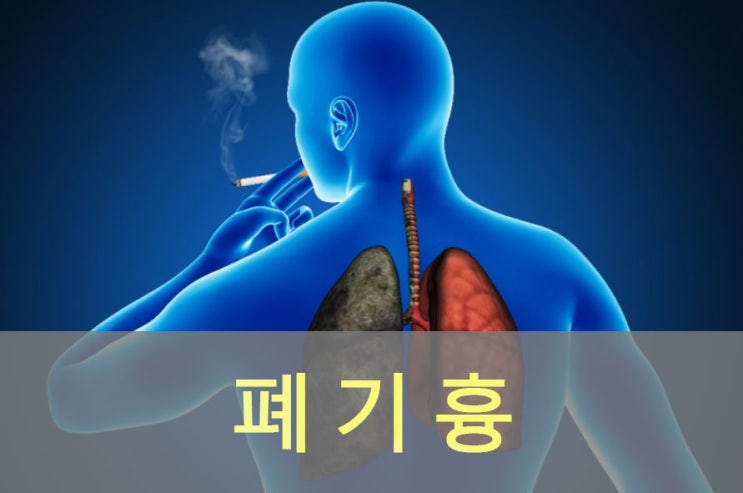  폐 기흉(공기가슴증) 원인과 증상, 예방