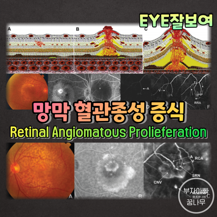  [EYE잘보여] 망막 혈관종성 증식(Retinal Angiomatous Proliferation; RAP)
