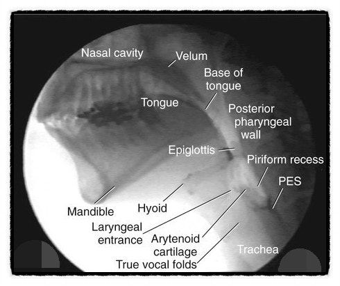 비디오 투시 삼킴검사  Videofluoroscopic swallowing study; VFSS