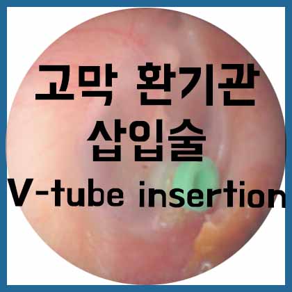  [귀] 고막 환기관 삽입술(V-tube insertion)
