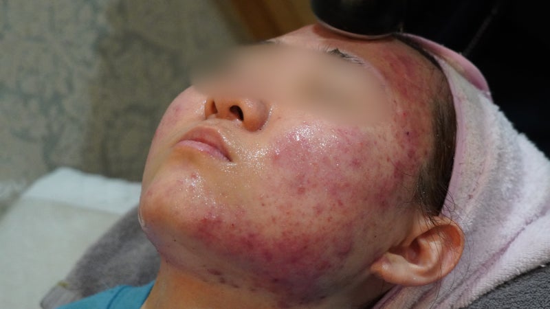 노원한의원 피부질환이 고민일 때