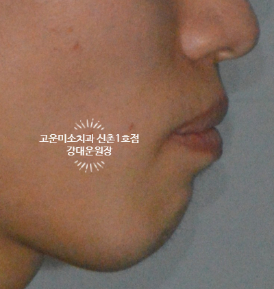  [발치교정,비대칭교정] 비대칭과 잇몸노출, 치열 불규칙, Gummy smile,