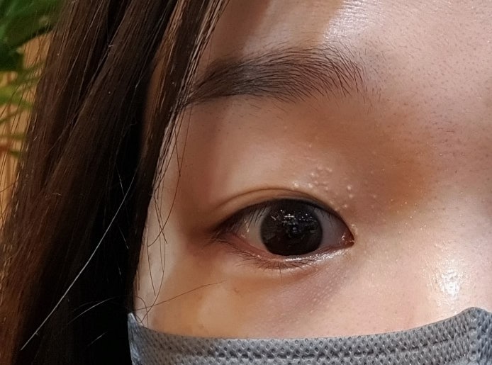 춘천 비립종 제거 피부과 가격 공유 (비쌈주의)