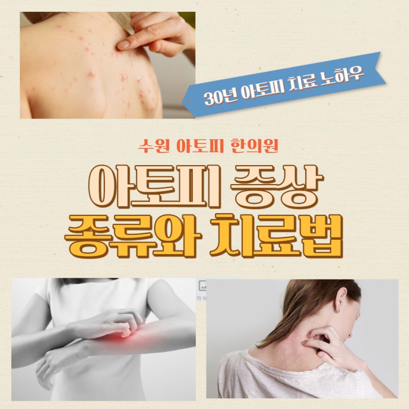 수원 아토피 피부과에서 이것저것 해봤다면 한방치료