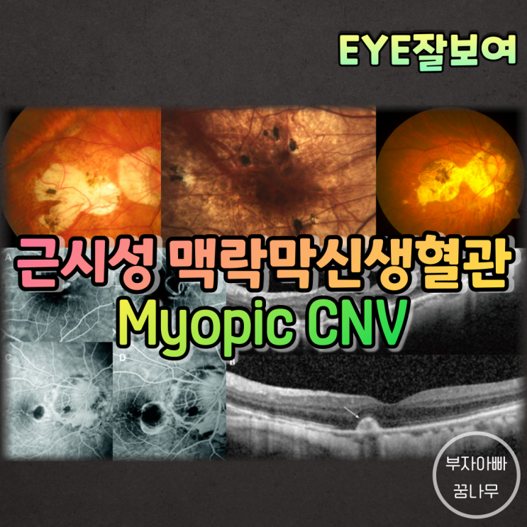 [EYE잘보여] 근시성 맥락막신생혈관(Myopic CNV) - 검사소견, 자연경과, 치료방법