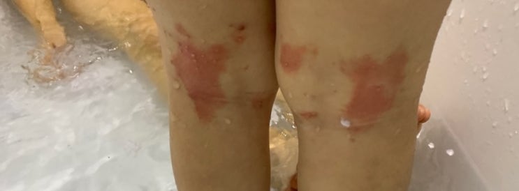  소아 물사마귀 방치하지 마세요.
