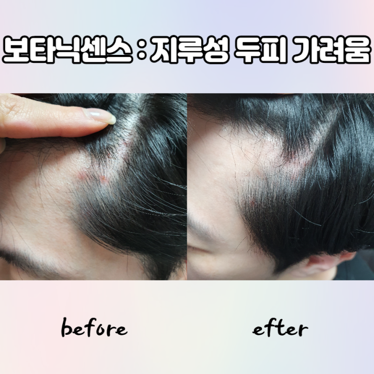 지루성 두피 가려움 보타닉센스 두피 세럼 추천 지루성 두피 가려움 보타닉센스 두피 세럼 추천