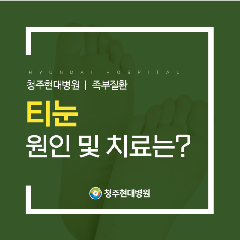 청주티눈 원인과 제거 치료 알아봐요