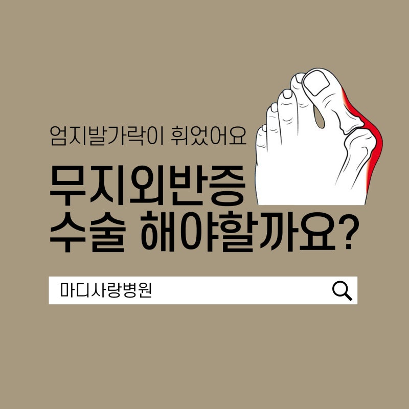 청주무지외반증 수술이 필요한 경우와 그 치료법
