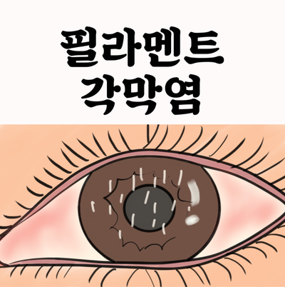 필라멘트 각막염 증상 제대로 알고 치료하자!