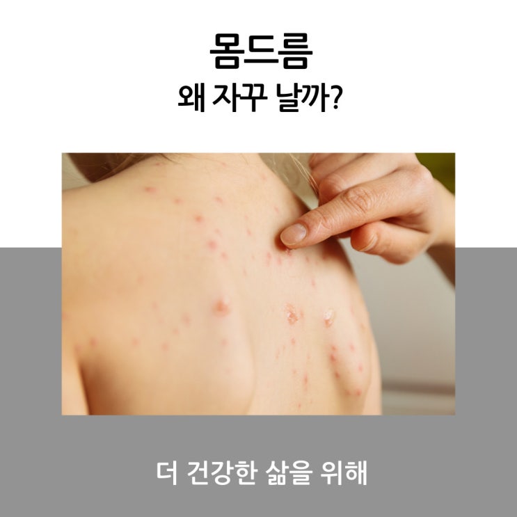 몸드름 몸에 발생하는 여드름은 왜 자꾸 날까?