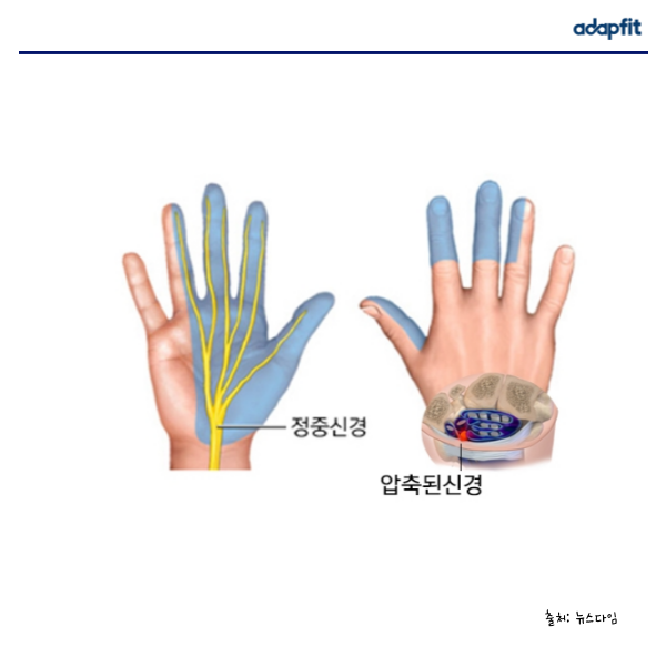 구서동 손목 통증 손목터널증후군 확인해 보세요!