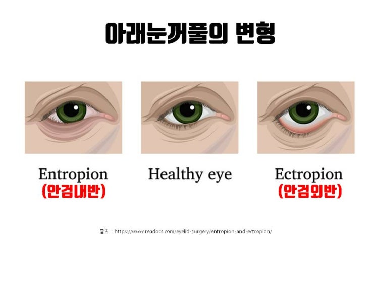  하안검수술 후 발생한 하안검퇴축, 쉽지 않지만 하안검재수술로 교정할 수 있어요!!!