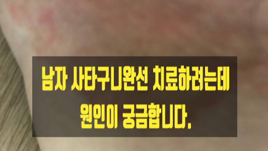  남자 사타구니완선 치료하려는데 원인이 궁금합니다.