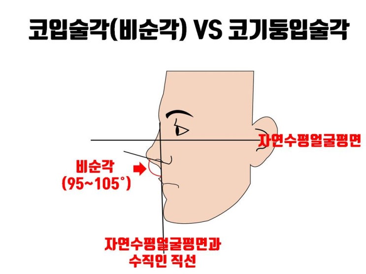  코수술 받을 때 코기둥과 입술의 각도가 불만이면 비순각 교정(고양이수술)으로 해결하세요!!!
