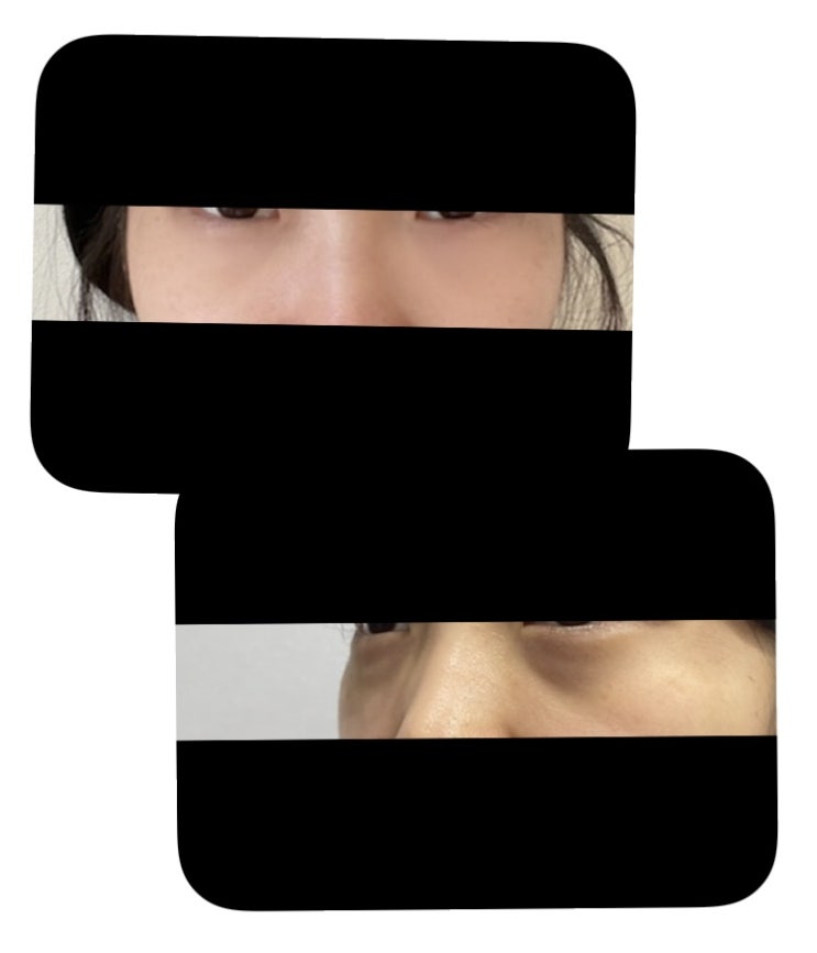 눈밑지방재배치 한달 실제 후기 (부작용,붓기,전후,통증,멍 등)
