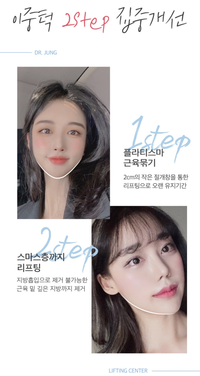 [이중턱근육묶기] 닥터정 리반의원의 3