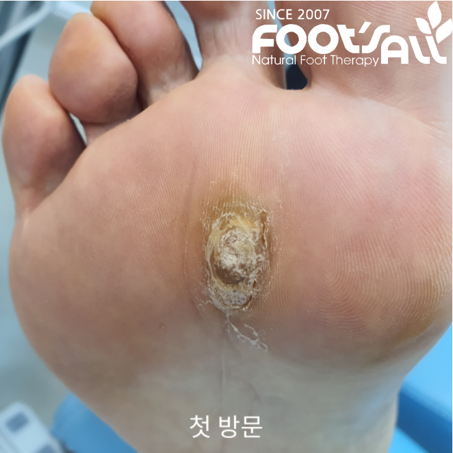  변형된 굳은살 드디어 마지막 관리!!