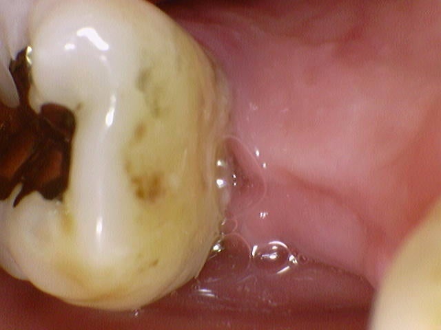 발치후 임플란트 늦어 치아정출, 강동구임플란트 4