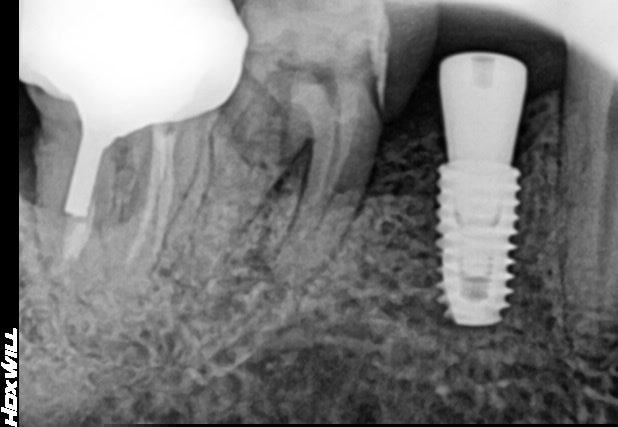 발치후 임플란트 늦어 치아정출, 강동구임플란트 6