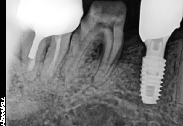 발치후 임플란트 늦어 치아정출, 강동구임플란트 3