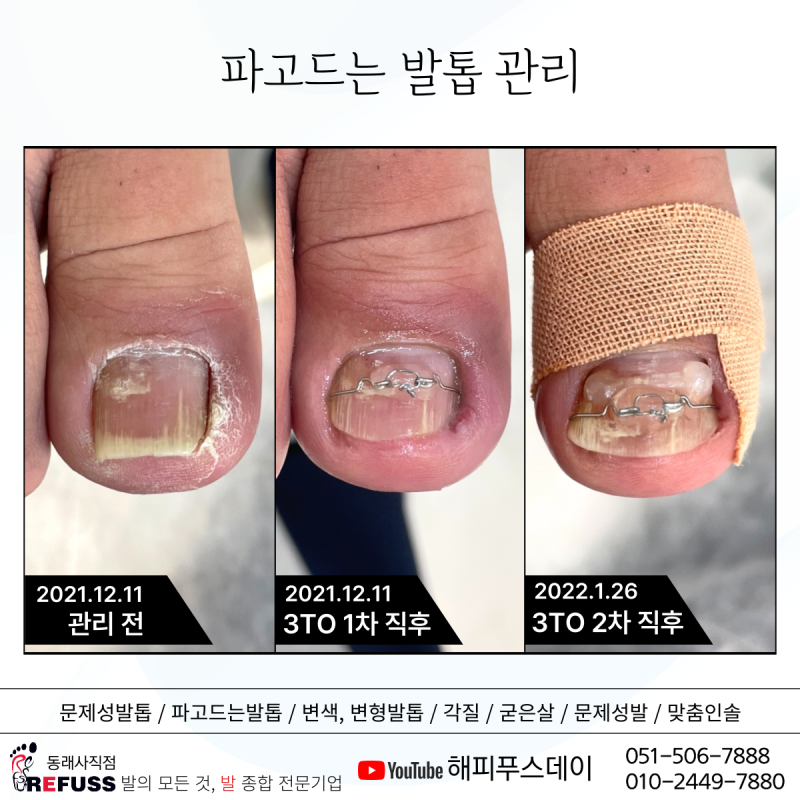 레퓌스 동래사직점 :: 부산 내성발톱 교정을 받고 왔습니다.