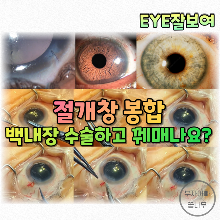  [EYE잘보여] 백내장 수술 - 절개창 봉합: 실로 꿰매나요? 안꿰매나요?