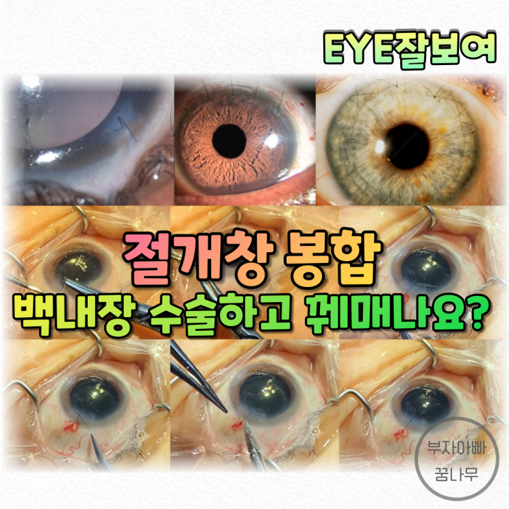 [EYE잘보여] 백내장 수술 - 절개창 봉합: 실로 꿰매나요? 안꿰매나요?