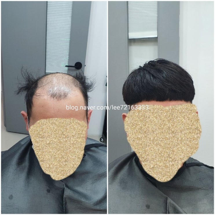  3만모? 6만모? 모발이식이아닙니다!헤어이식증모 가발덕후은주누나 춘천가발전문점 [김호증모가발]