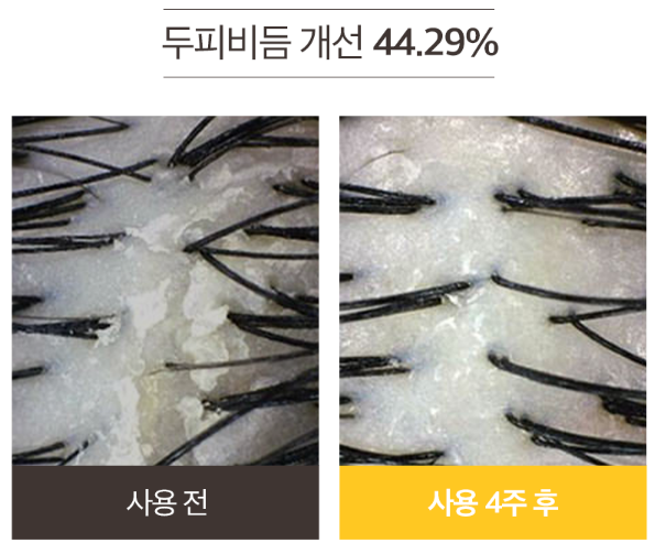  메디올 두피청정샴푸, 비듬+가려움 싹 잡아주네요.